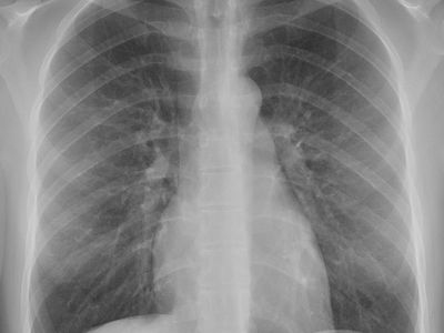 Chest X-ray