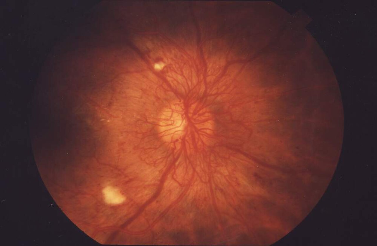 Colour fundus photograph of a right eye