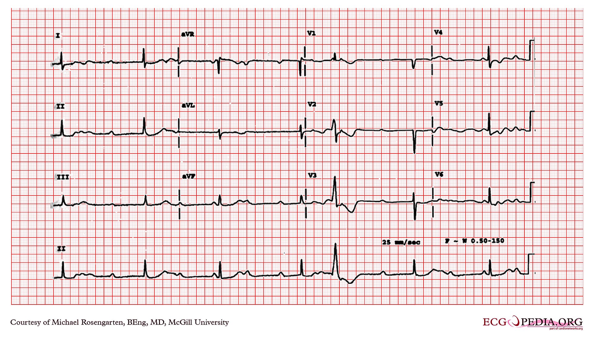 Twelve-lead electrocardiogram recorded at 25 mm/s