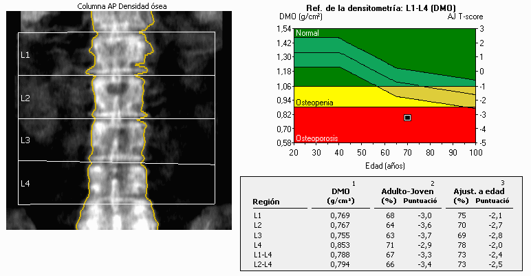 Lumbar spine page of a dual-energy X-ray absorptiometry report