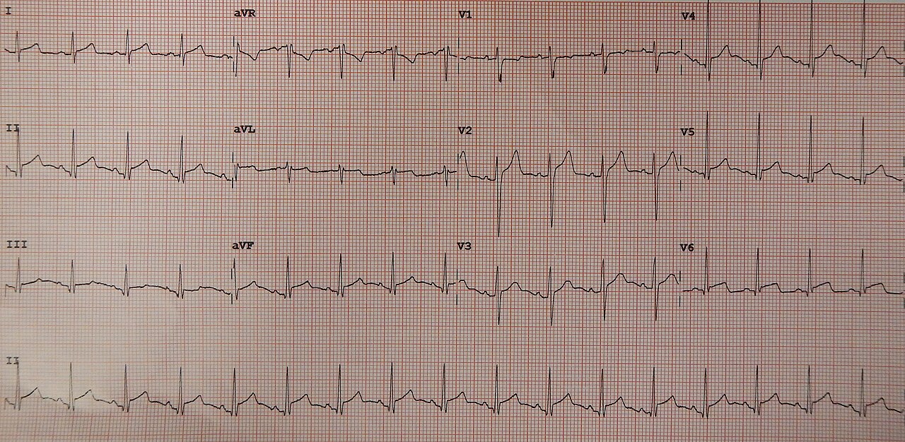 Twelve-lead electrocardiogram recorded at 25 mm/s